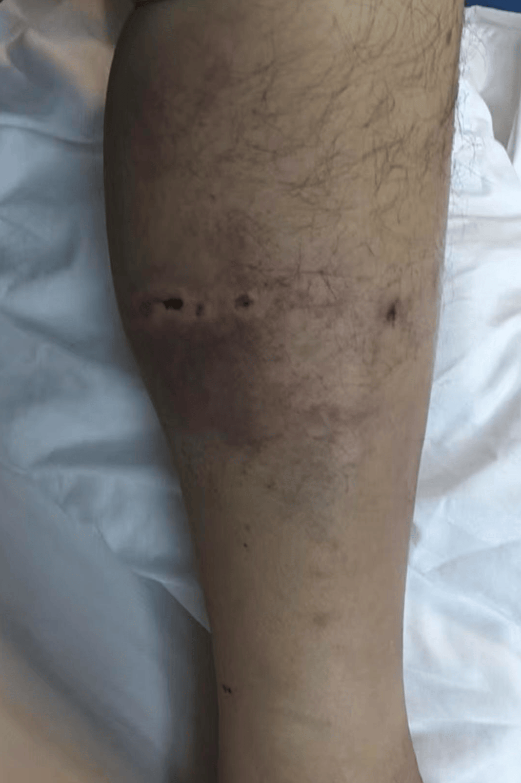 重庆男子上山采菌正面遇黑熊袭击,当事人:小腿被咬,穿的水鞋救了我一命;遭一掌打下山坡后险坠山崖幸被树枝拦住,醒后找到手机求救