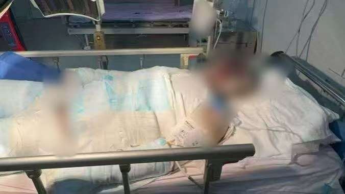 父子在哈尔滨一亲戚公司上班遇爆炸全身烧伤,治疗花费近百万公司拒赔偿?亲戚回应