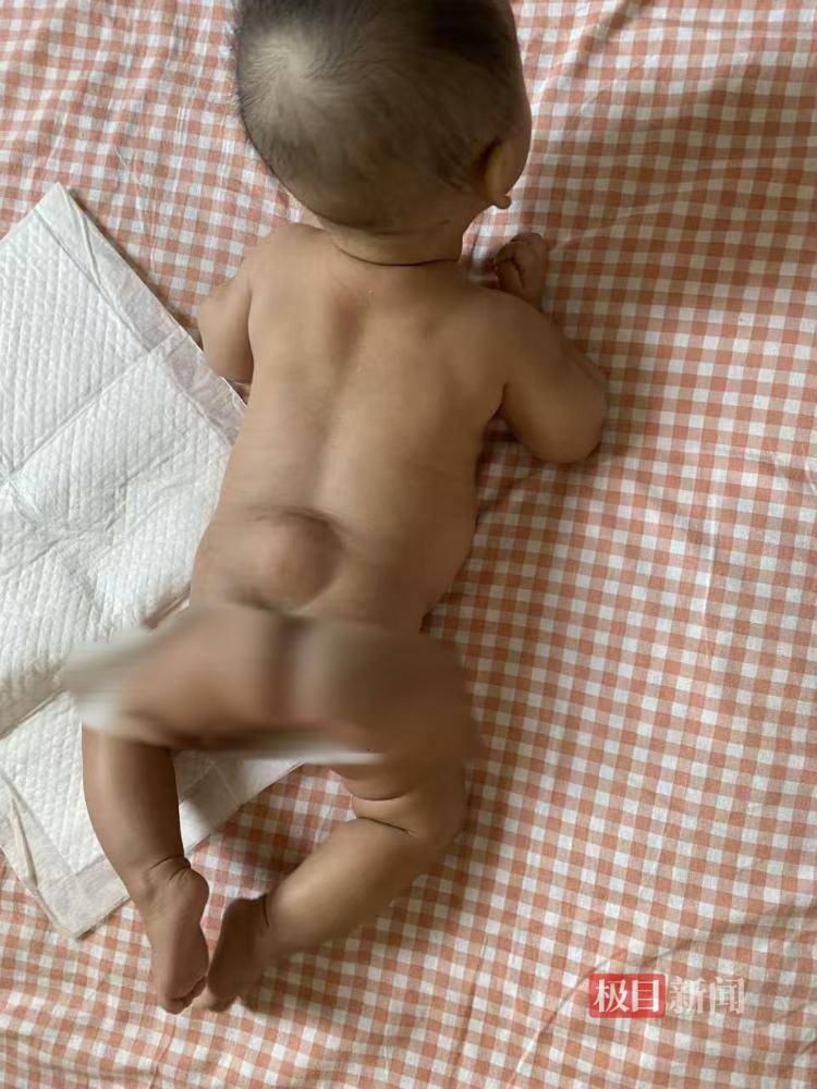 沈阳一女婴出生半年确诊“脊柱裂”，宝妈称“大排畸”正常，涉事医师无产前诊断资质，当地卫健委介入